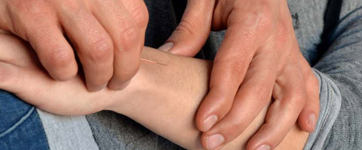 Beneficios de la Acupuntura Zonal
