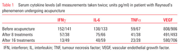 Síndrome de Raynaud